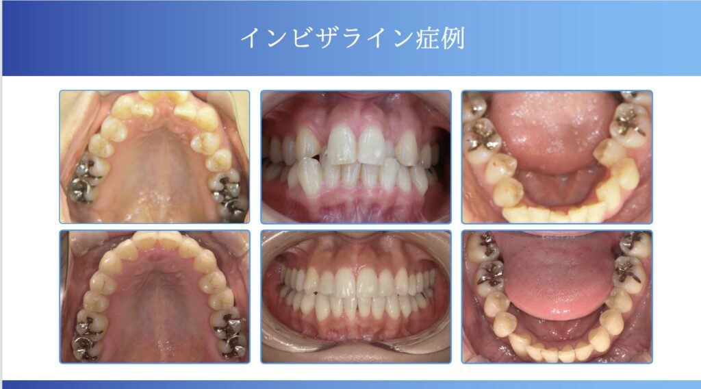 治療前後の口腔内写真