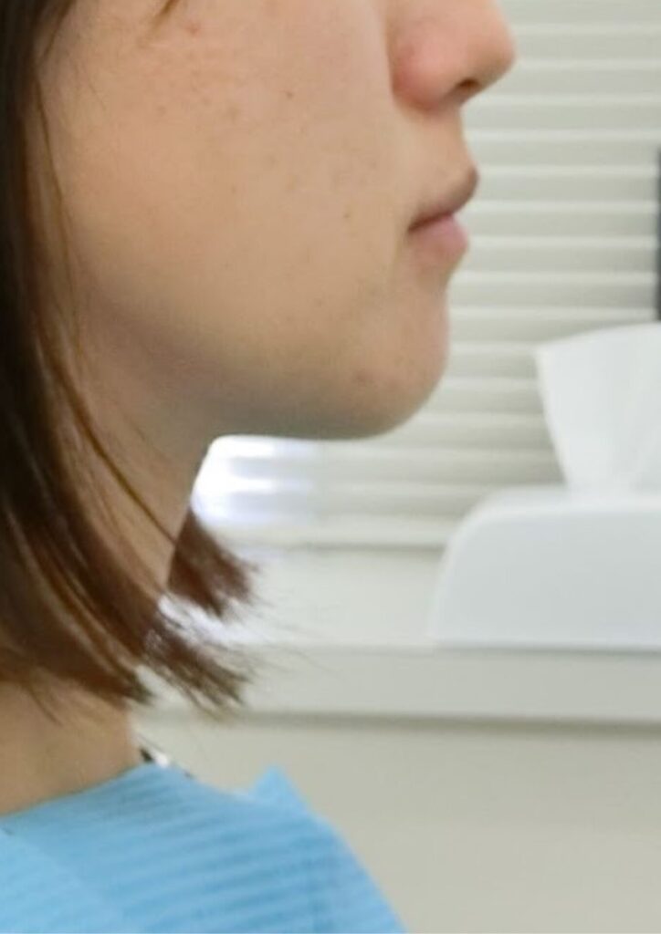 治療前の顔貌写真