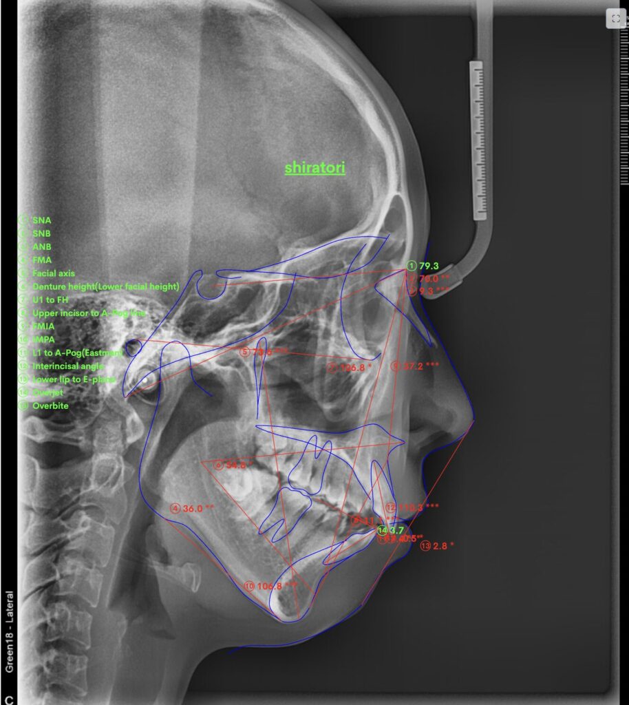 セファロX線写真