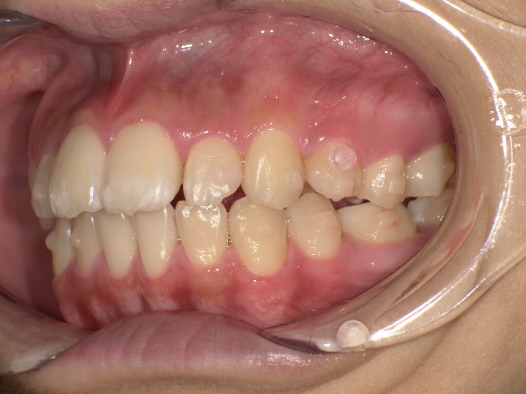 治療開始から半年前後で、口元の突出感が和らぎ、前歯が下がってきていると感じ始める