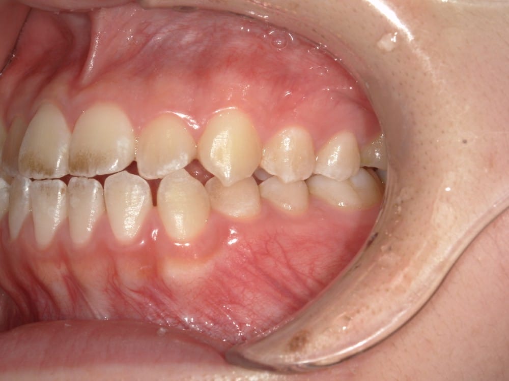 （奥歯のズレが半歯程度）