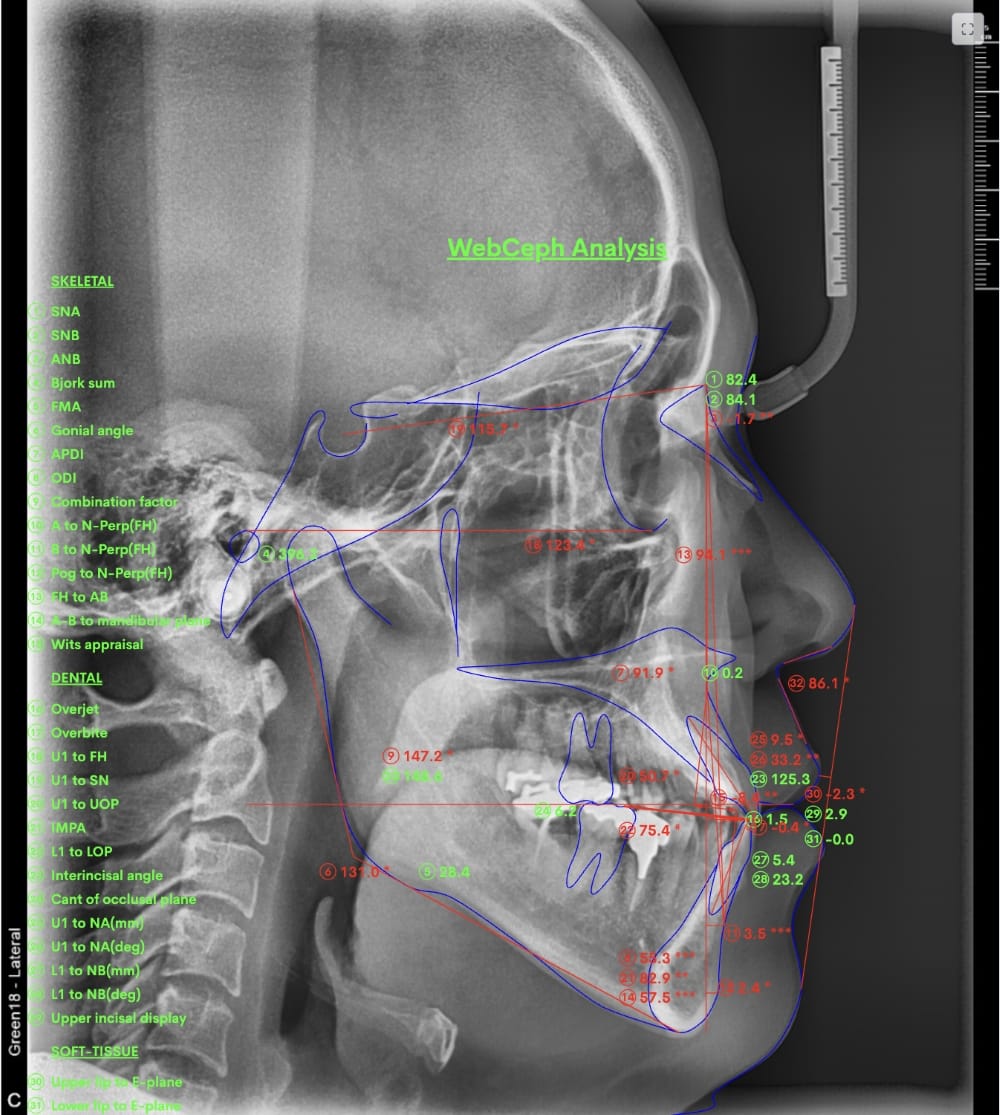 セファロX線写真