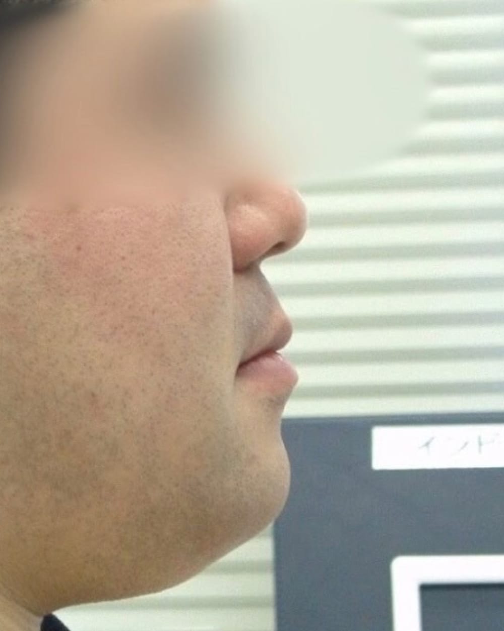 受け口とガタガタを主訴