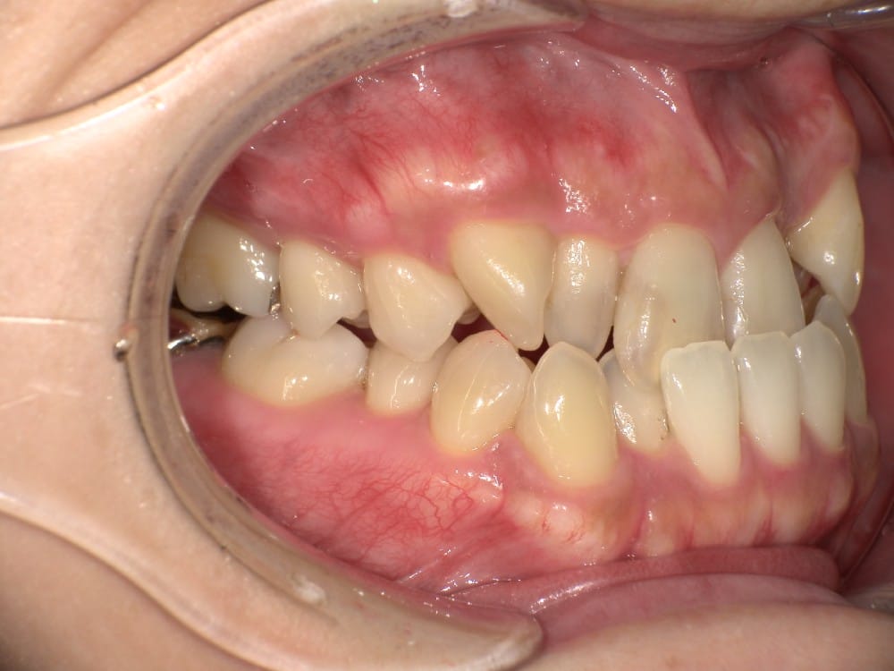 歯性と骨格性が混在しているタイプ