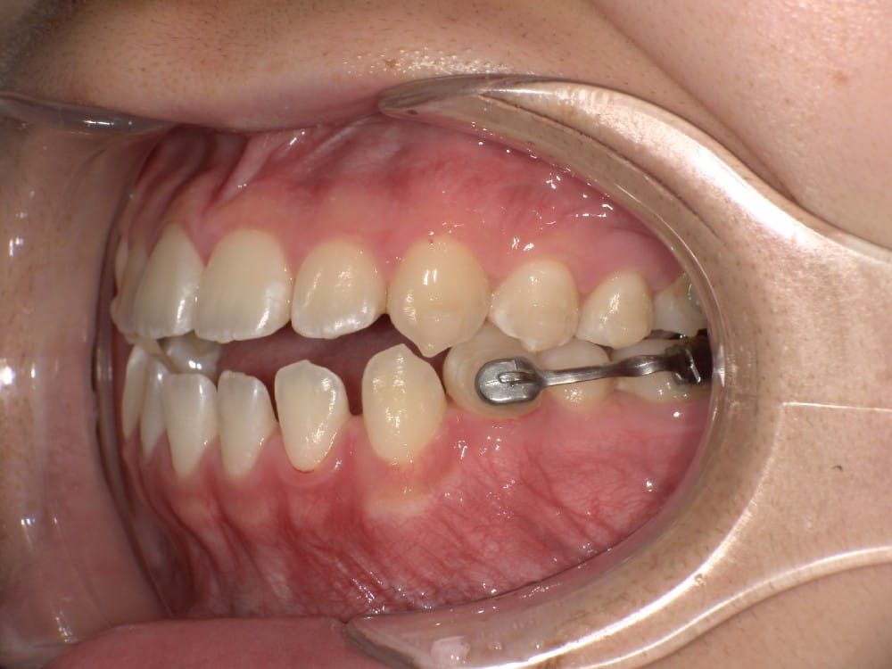 （カリエール終了時）