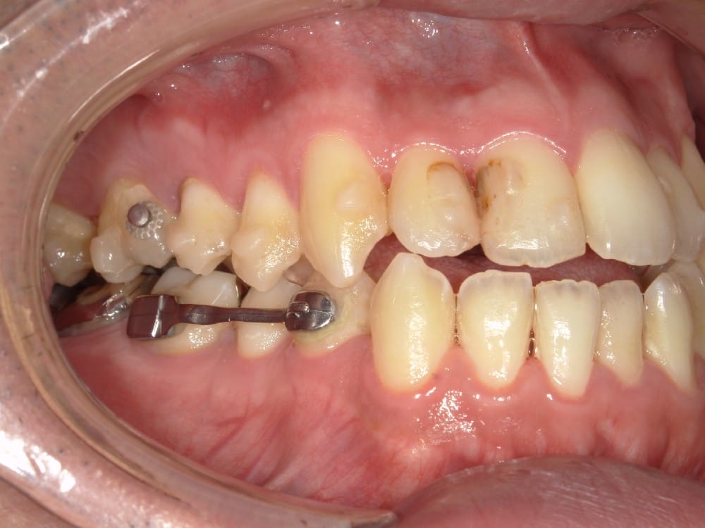 （カリエール終了時） 