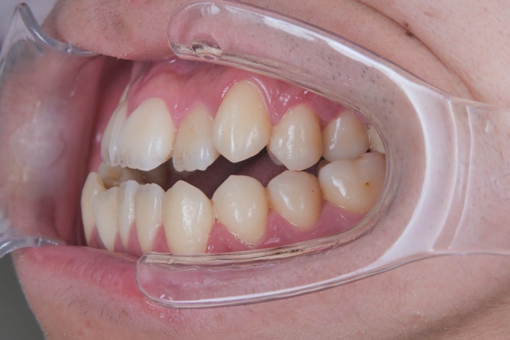 （奥歯のズレが1本以上）