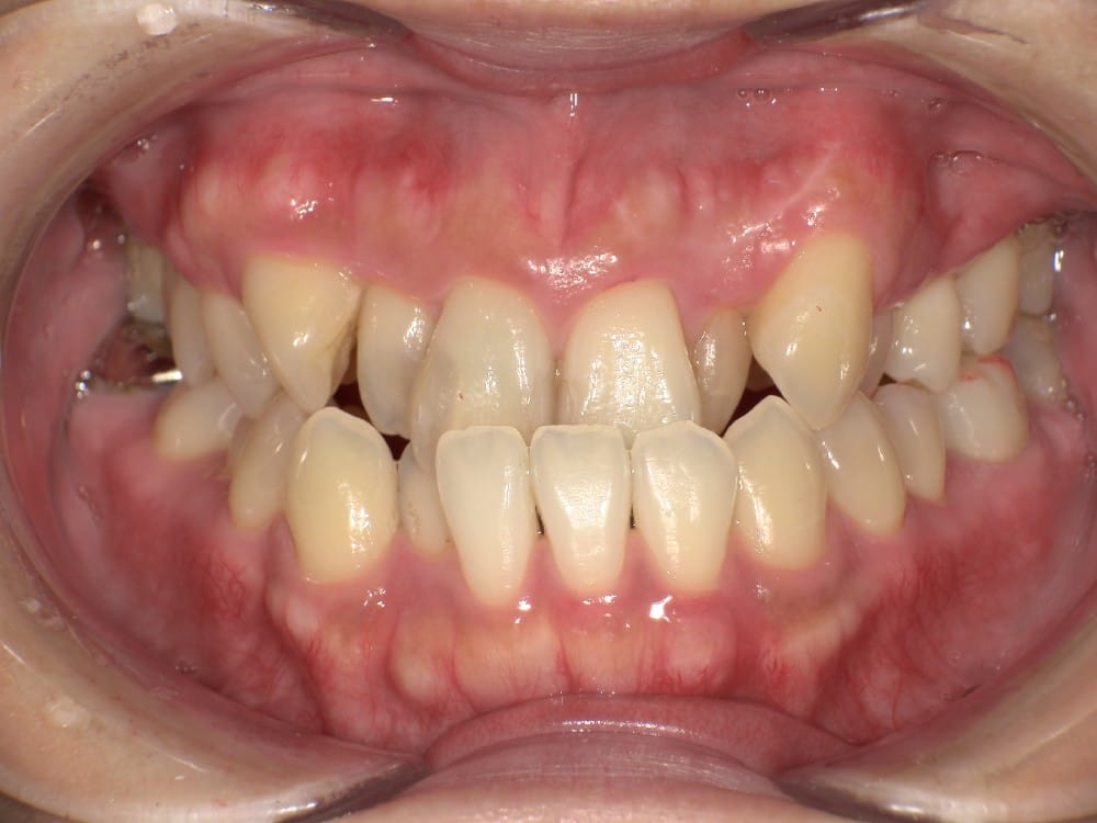 受け口とガタガタを主訴