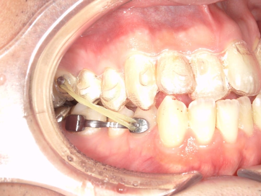 （カリエール開始時） 