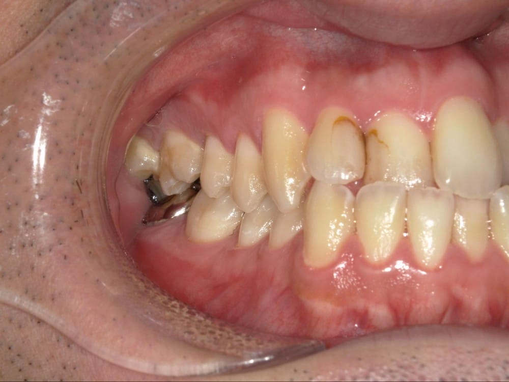 受け口とガタガタを主訴
