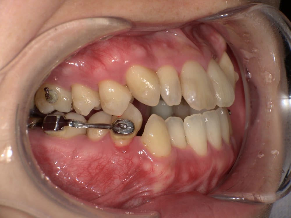 （カリエール終了時）