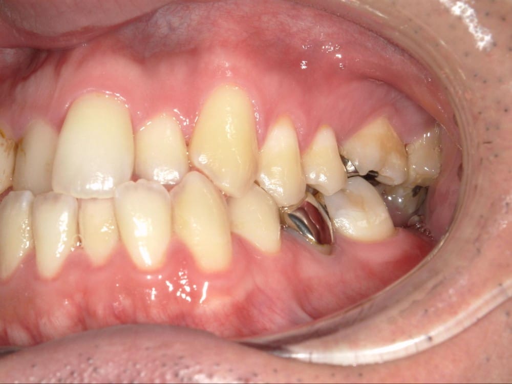 受け口とガタガタを主訴