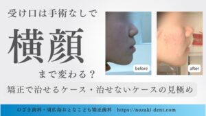 受け口は手術なしで横顔まで変わる？