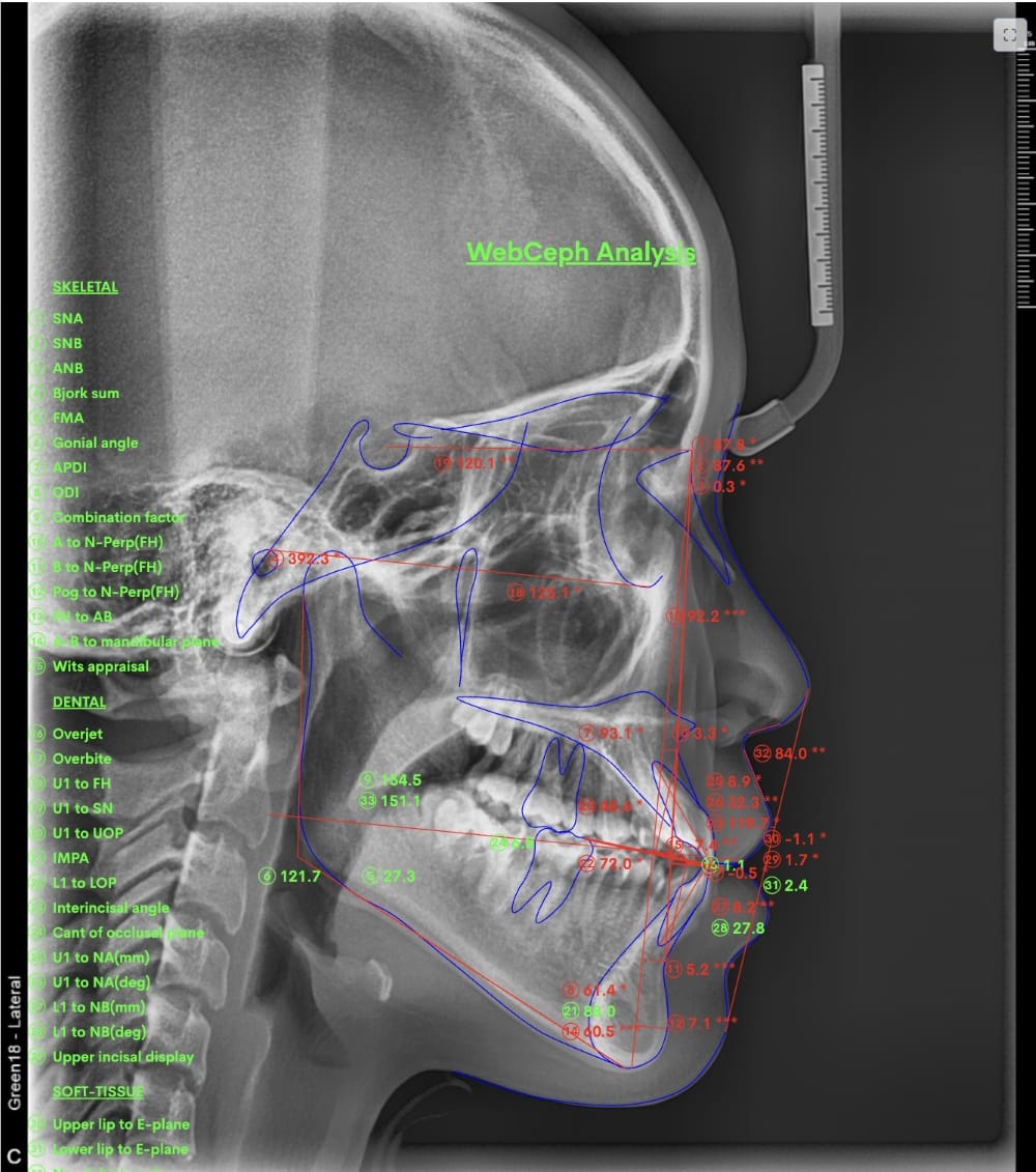 セファロX線写真