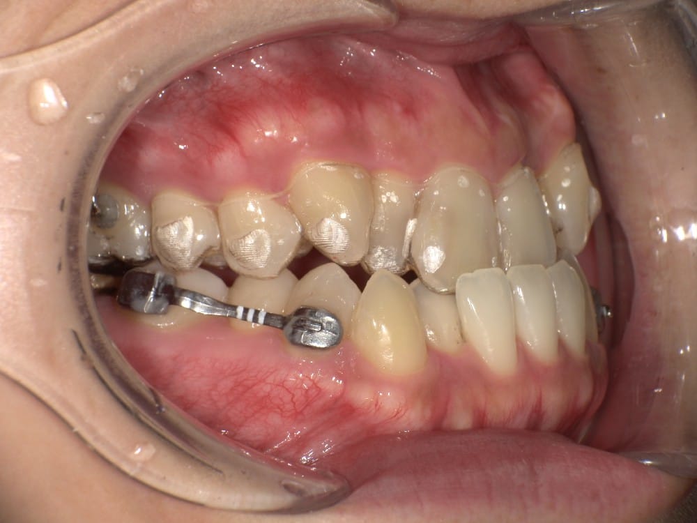 （カリエール開始時）