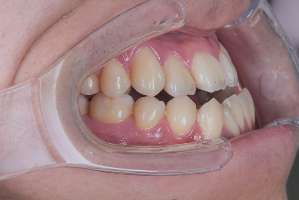 あごの大きさ・位置が原因（骨格性の受け口）