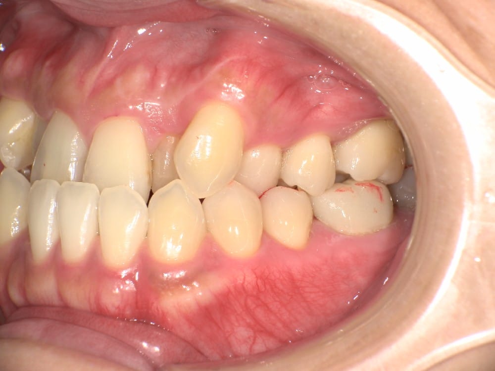 （奥歯のズレは少ない）