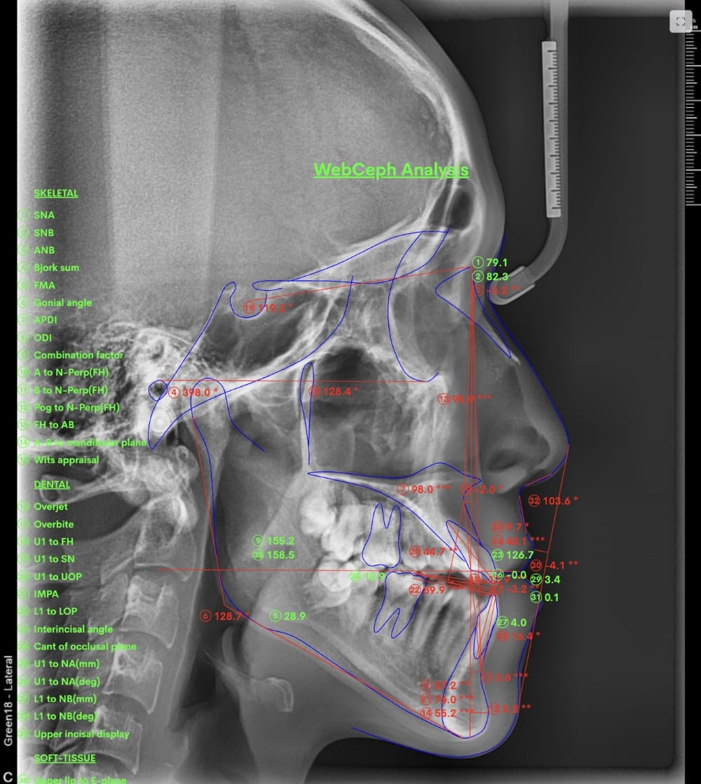 セファロX線写真