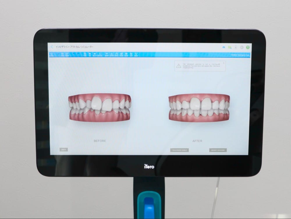 3Dシミュレーション（iTero）