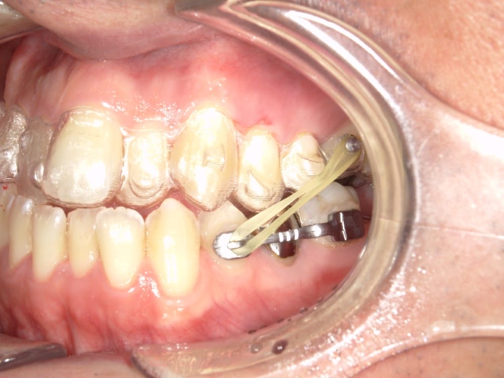 顎間ゴム（ゴムかけ）