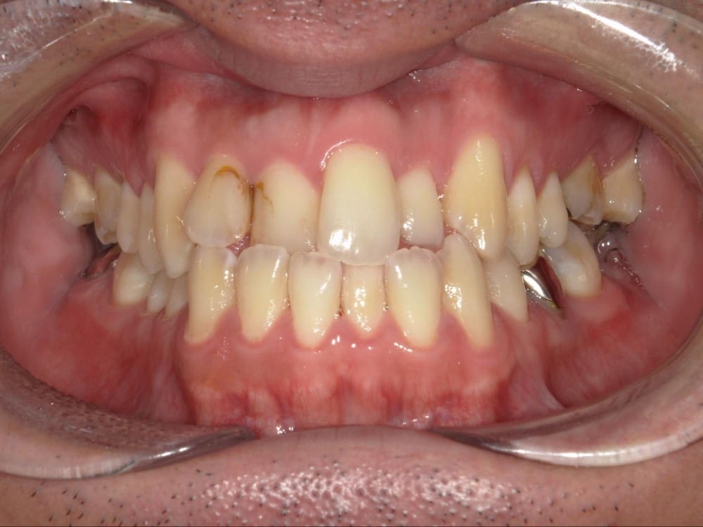 受け口とガタガタを主訴