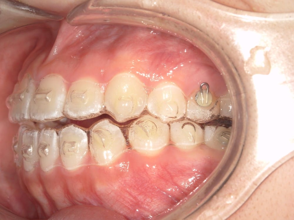 上下透明なマウスピース