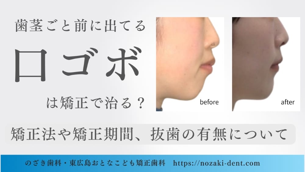 歯茎ごと前に出てる口ゴボは矯正で治る？治療法や矯正期間、抜歯の有無について