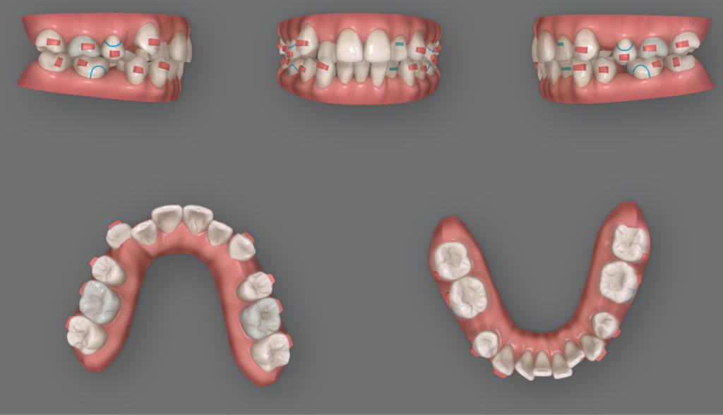 ４本歯を抜いた場合の半年後の治療予想図