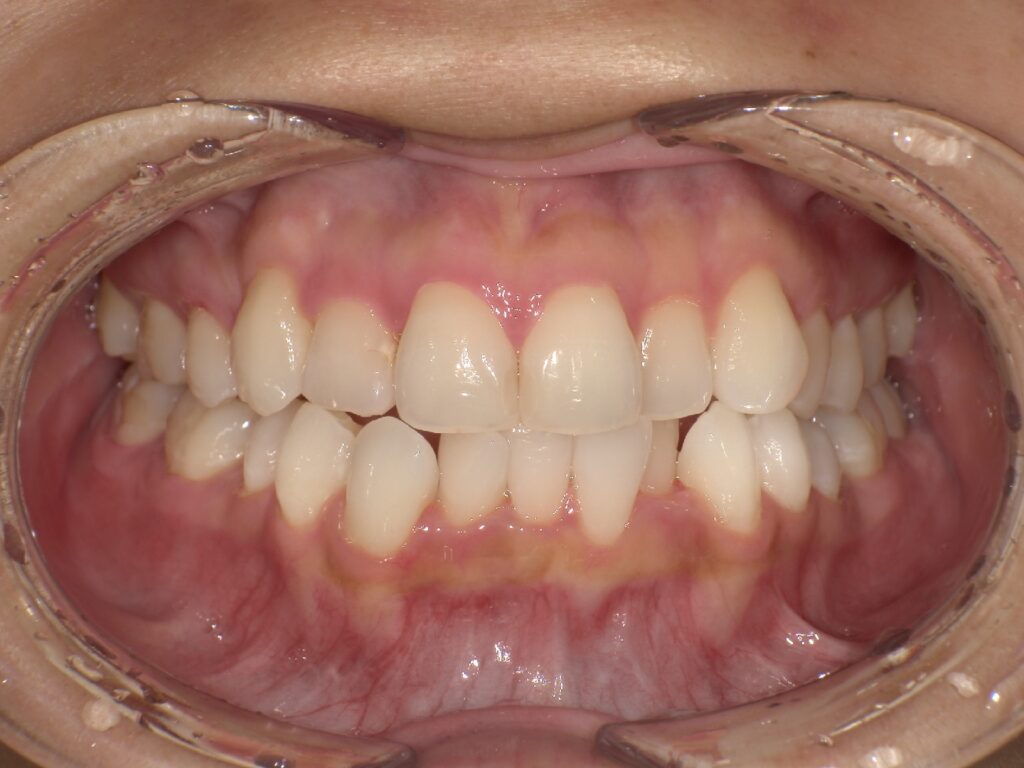 矯正治療開始して半年後の結婚式前の写真