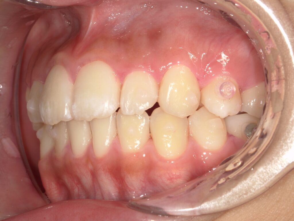 1年程度で、写真や鏡で見ても「前歯が下がった」とはっきり分かる状態になる