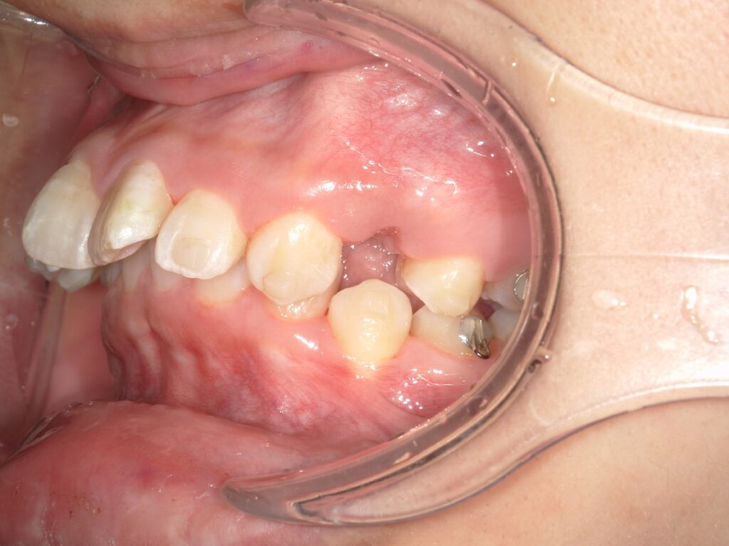 抜歯矯正開始時