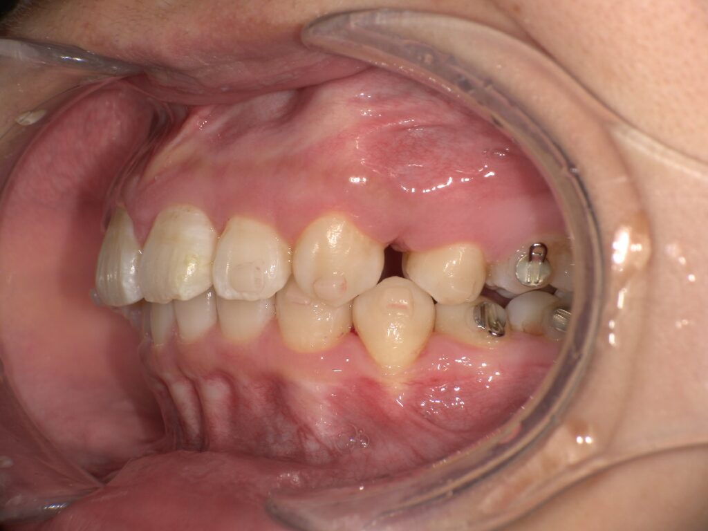 抜歯矯正開始後８ヶ月後