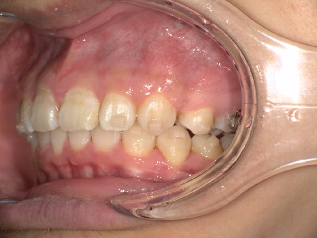 抜歯矯正開始１５ヶ月後