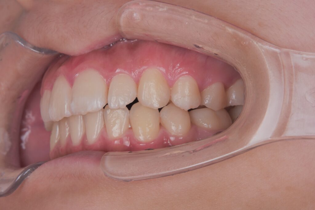 噛み合わせまでしっかり整え、終了時の写真
