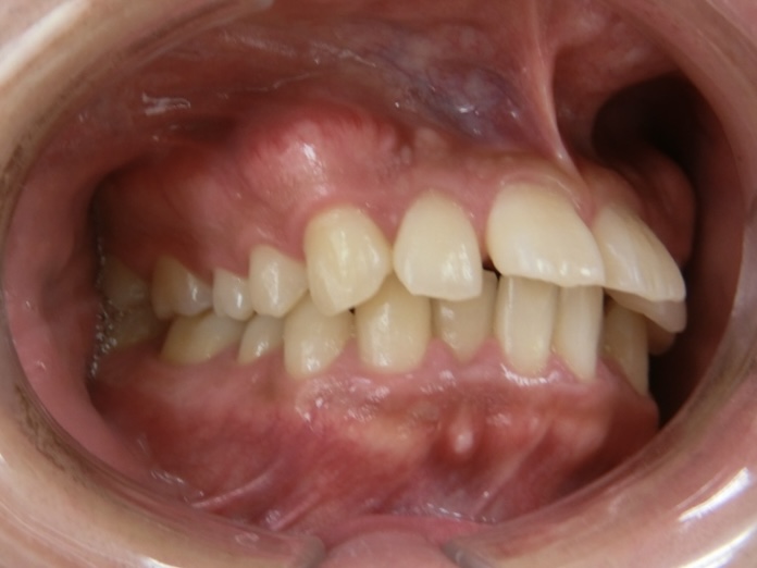 開始時の写真　上顎の前歯が大きく突出しています