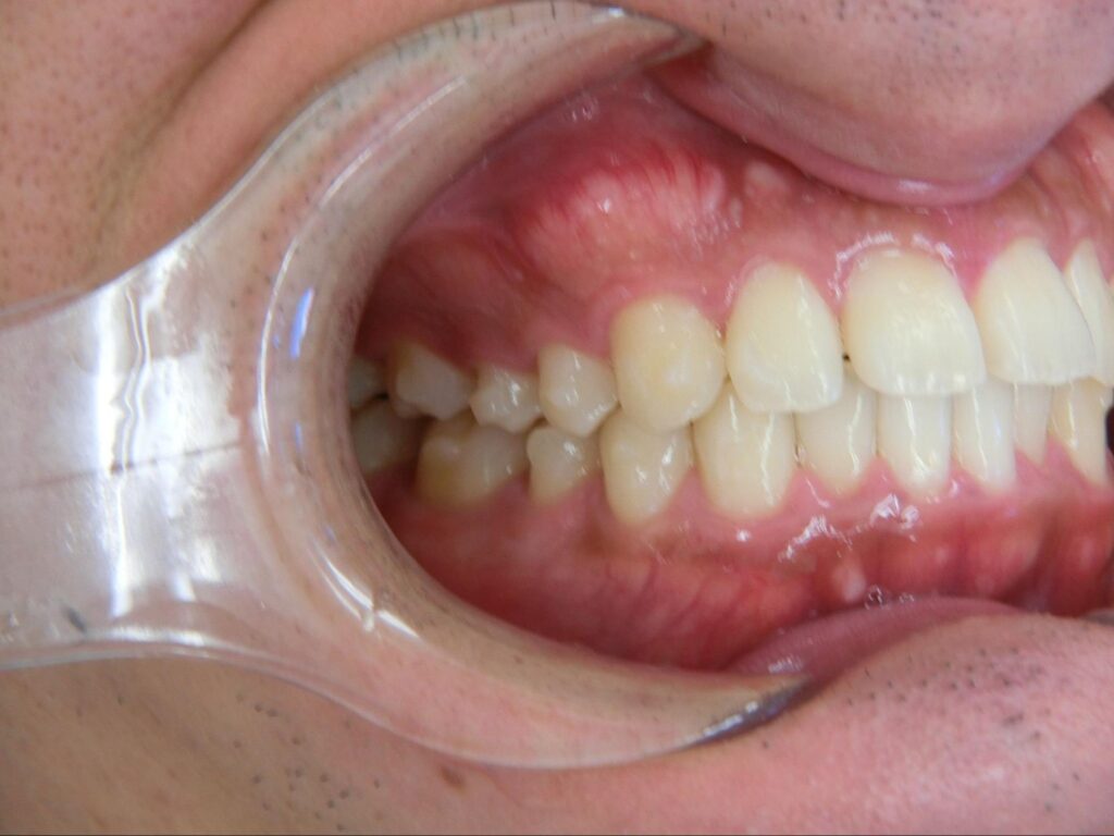 ４ヶ月後　明らかに前歯の突出感が改善し、患者様はこの時点でとても喜ばれていました