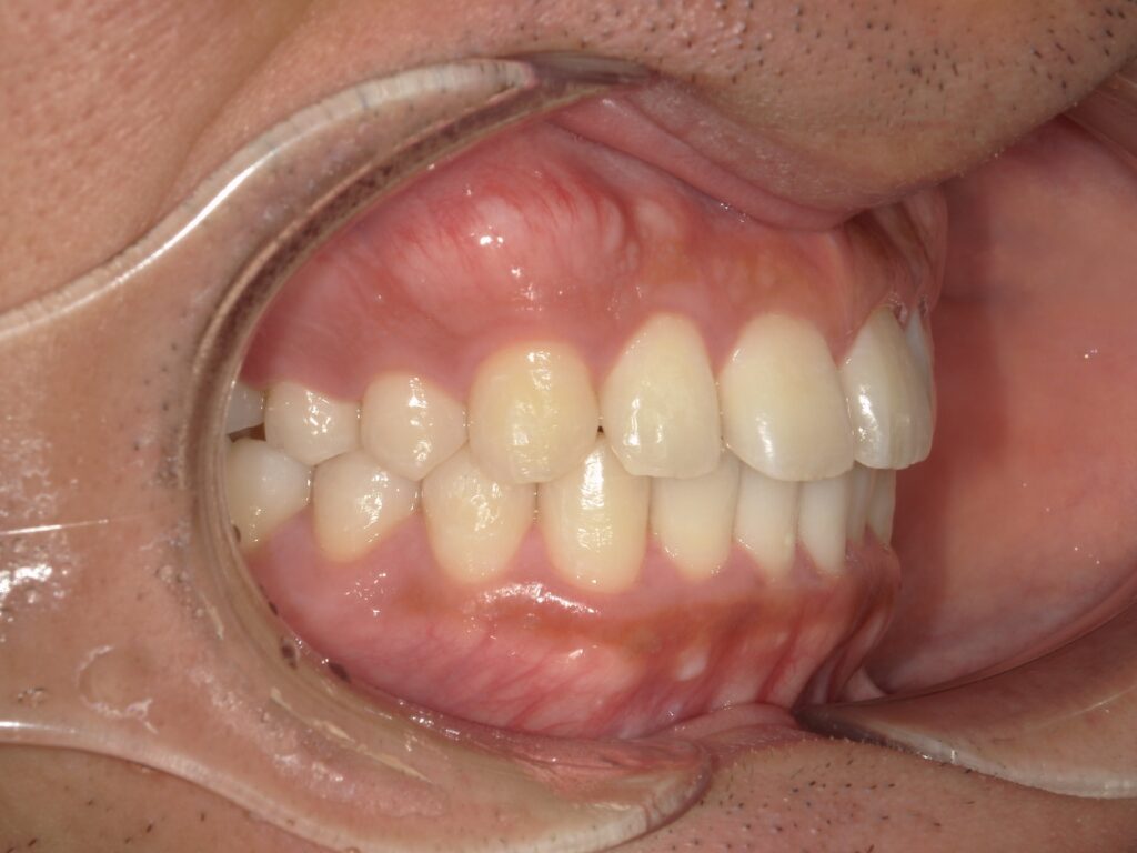 １１ヶ月後　矯正治療終了時　部分矯正ということもあり、短期間で矯正治療を終了することができました