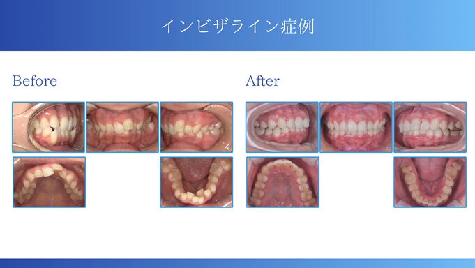 インビザライン症例