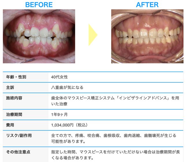 インビザライン症例