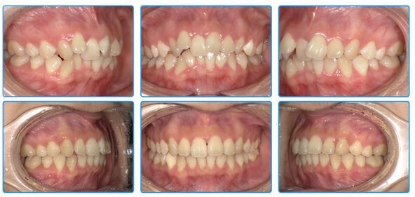 インビザライン症例