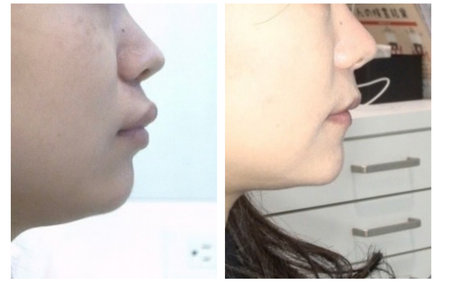 インビザライン症例