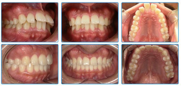 インビザライン症例