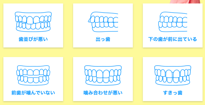 インビザライン症例