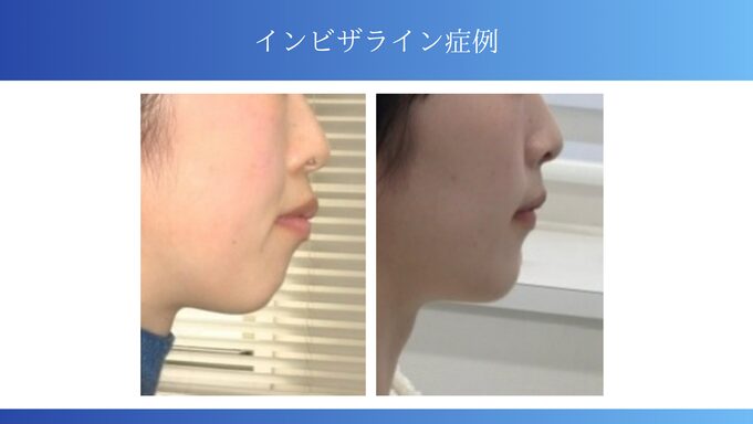 インビザライン症例