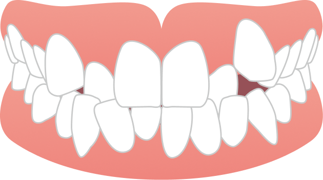 ガタガタ・八重歯