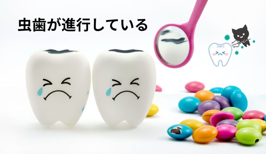 虫歯が進行